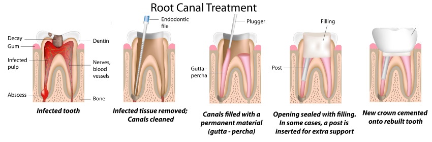 Illustration showing the stages of root canal therapy