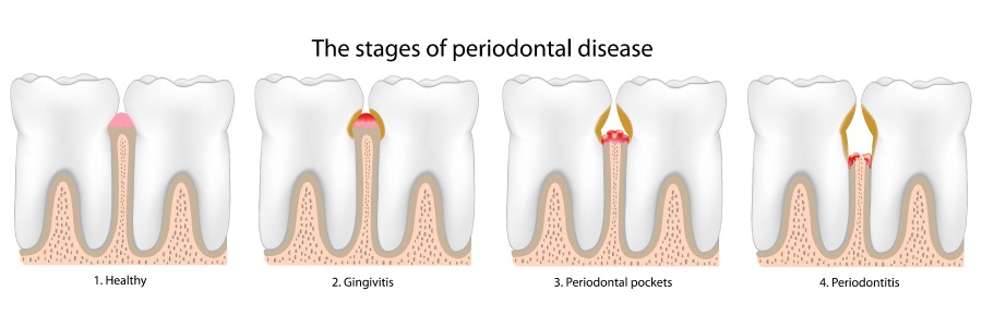 Graphic showing stages of gum disease.