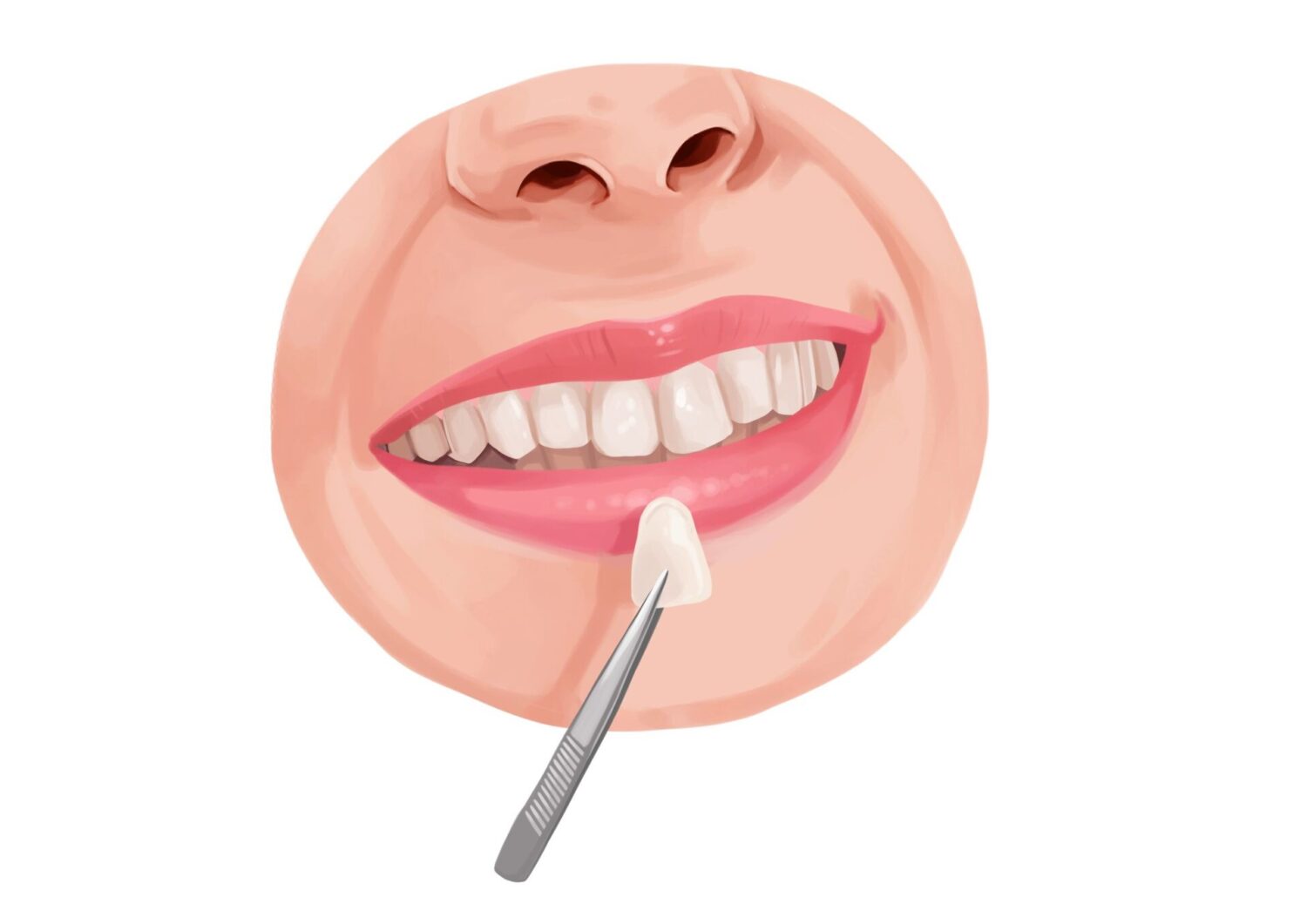 closeup illustration of a woman's mouth with a dental veneer being held up next to her teeth